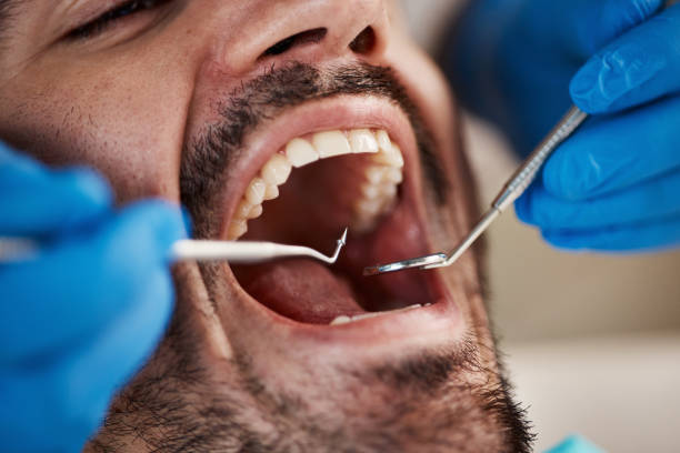 Best Knocked-Out Tooth (Avulsed Tooth) Treatment in Countryside, VA